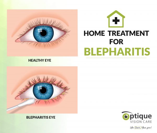 Home Treatment for Blepharitis Optique Vision Care